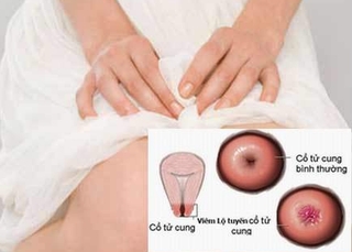 Viêm cổ tử cung (chẩn đoán và điều trị)